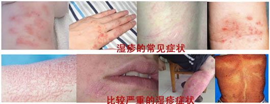 湿疹的症状