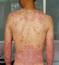 鱼鳞病症状