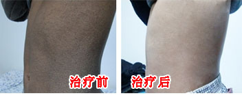 鱼鳞病康复