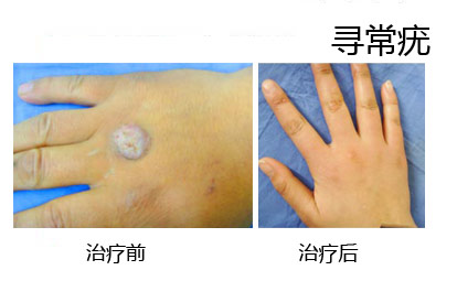 寻常疣治疗前后对比图
