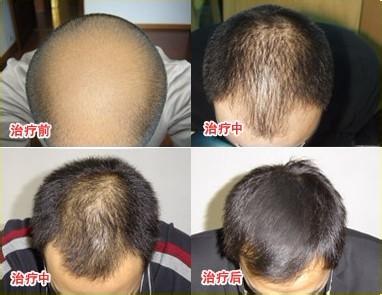 斑秃治疗前后对比图