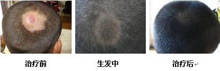 斑秃治疗前后对比图