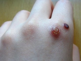 如何预防寻常疣