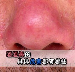 酒糟鼻的危害