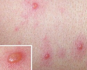 带状疱疹怎样的预防