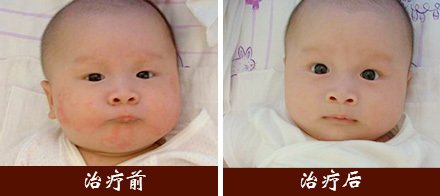 湿疹的注意事项有哪些