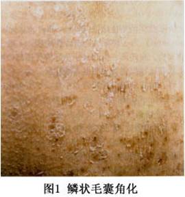 如何诊断鳞状角化症呢?