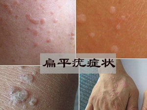 如何预防扁平疣
