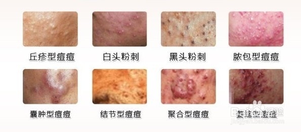 青春痘的皮损有哪些