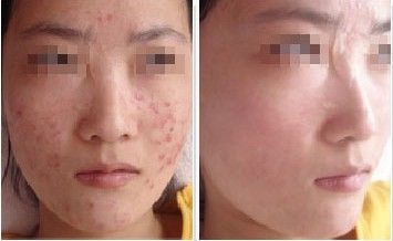痤疮要怎么预防较好